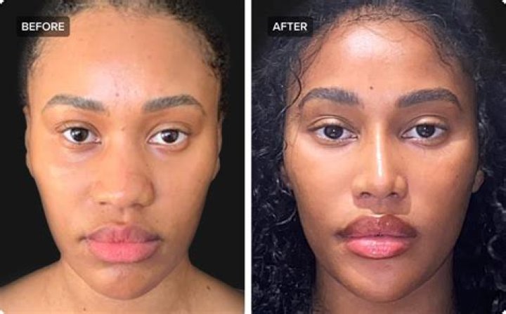 Allison Kuch Nose Job: Plastic Surgery Before And After