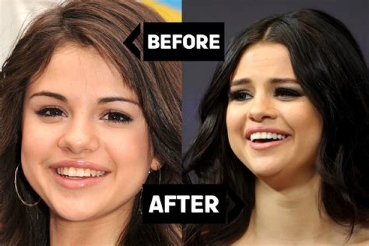 Does Selena Gomez Have Veneers? New Teeth Before And After