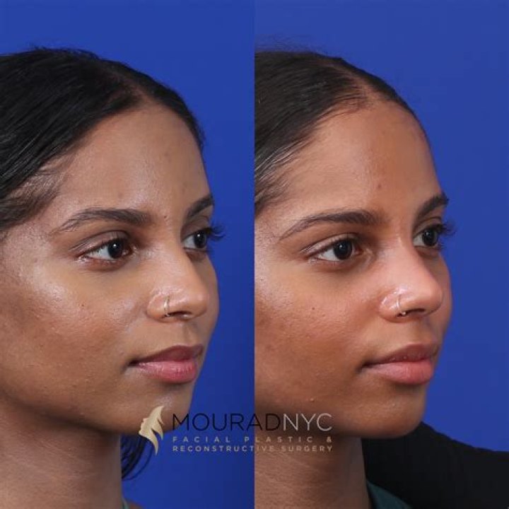 Taylor Love Is Blind Plastic Surgery: Nose Job Before And After