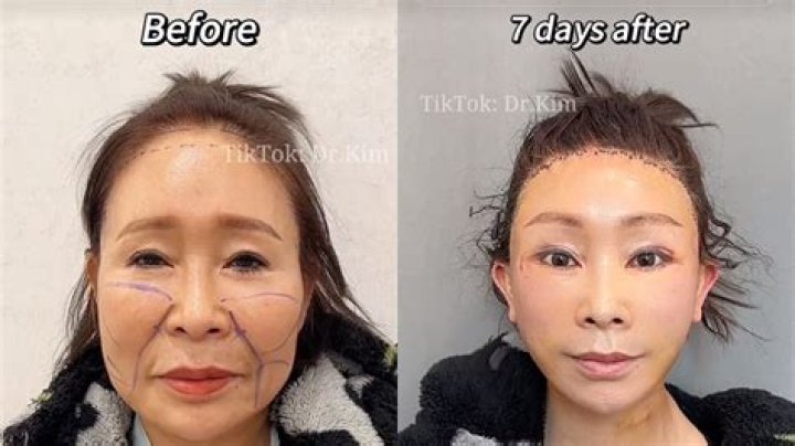 Yuta Nakamoto Plastic Surgery: Before And After Photos